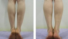 小腿抽脂術(shù)后會不會容易反彈？