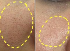 去黑頭小竅門(mén)：這幾個(gè)方法很有！