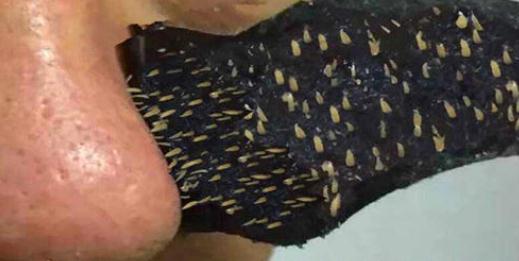 去除黑頭的小分子