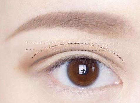 做完雙眼皮之后眼睛睜不開是怎么回事?