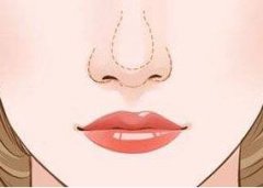 蒜頭鼻做鼻尖成形術(shù)改良果好嗎？美麗鼻子~