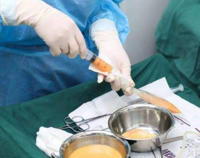 玻尿酸或自體脂肪填充那個貴?