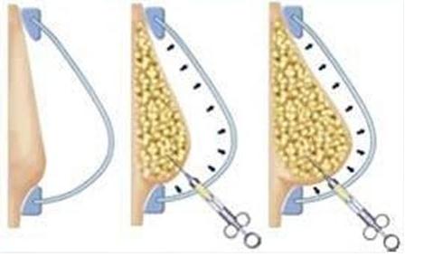 注射隆乳的優(yōu)點(diǎn)