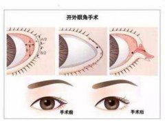 開內(nèi)眼角術后果如果不理想該怎么辦？