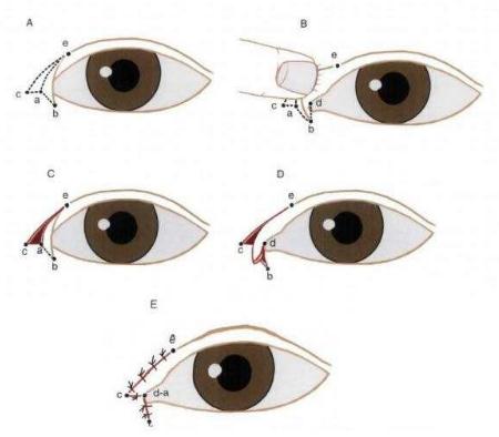 開內(nèi)眼角術后果如果不理想該怎么辦?