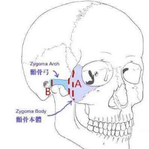 磨骨手術(shù)和顴骨內(nèi)推有什么區(qū)別？哪個(gè)風(fēng)險(xiǎn)大？