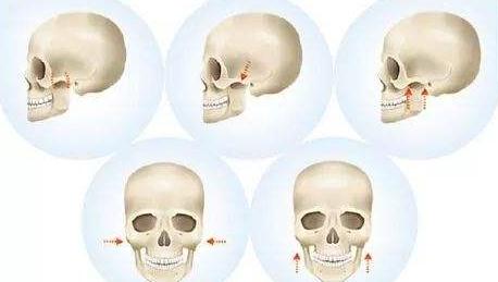 顴骨內(nèi)推和磨骨哪個(gè)風(fēng)險(xiǎn)大？