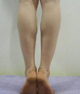 抽脂后注意事項(xiàng)