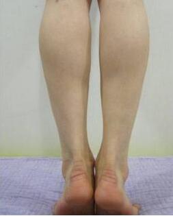 抽脂后注意事項(xiàng)