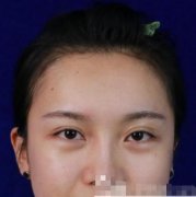 聽說曹仁昌醫(yī)生技術(shù)很牛，找他做雙眼皮修復(fù)！