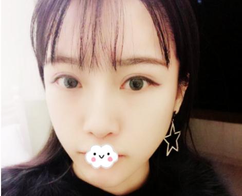 曹仁昌醫(yī)生做雙眼皮修復(fù)術(shù)后半個月