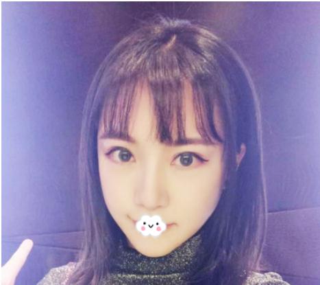 曹仁昌醫(yī)生做雙眼皮修復(fù)術(shù)后三個月