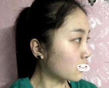 我在合肥維多利亞做了鼻部手術(shù)手術(shù)果~