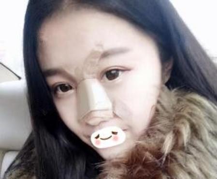 合肥維多利亞做鼻部手術(shù)手術(shù)術(shù)后第4天