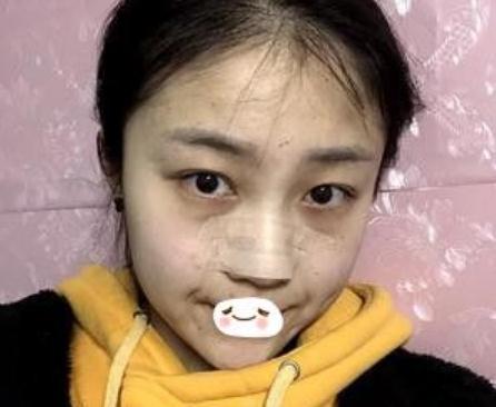 合肥維多利亞做鼻部手術(shù)手術(shù)術(shù)后拆線