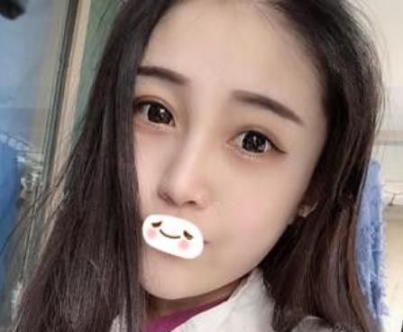 合肥維多利亞做鼻部手術(shù)手術(shù)術(shù)后三個月