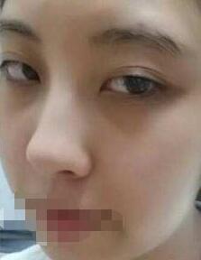 激光去黑眼圈有什么副作用?