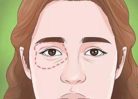 激光去黑眼圈有什么副作用?