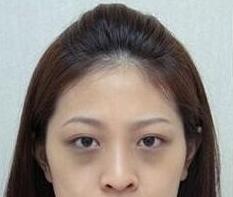 激光去黑眼圈有什么副作用?