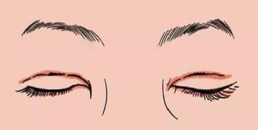 做完雙眼皮之后眼睛睜不開是怎么回事?