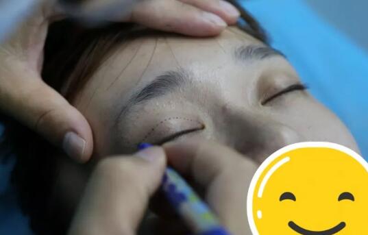 雙眼皮手術(shù)前的狀況