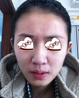 做一個點(diǎn)陣激光祛痘坑要多少錢?