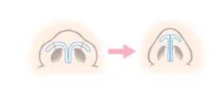 蒜頭鼻做鼻尖成形術(shù)改良果