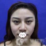 看我在東莞韓美做的隆鼻修復，讓我重獲新生！