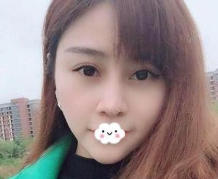 東莞韓美做的隆鼻修復手術術后三個月