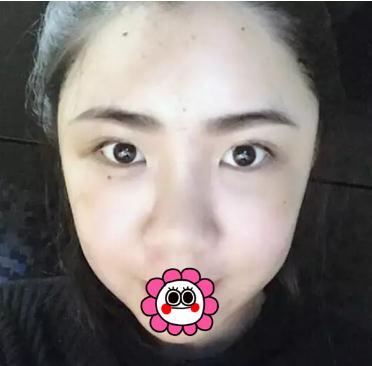 哈爾濱成美做了脂肪填充全臉手術(shù)術(shù)后半個月