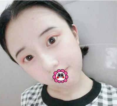 哈爾濱成美做了脂肪填充全臉手術(shù)術(shù)后一個月