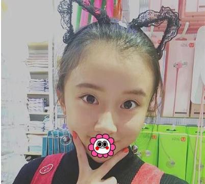 哈爾濱成美做了脂肪填充全臉手術(shù)術(shù)后半年