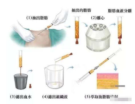 馮斌醫(yī)生對于自體脂肪技術的研究