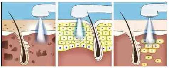 光子嫩膚能維持多久?