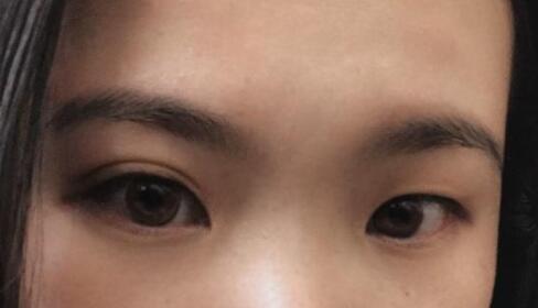 雙眼皮不對(duì)稱
