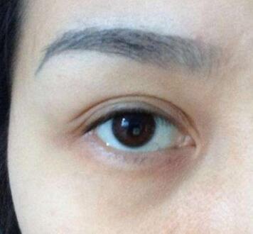 形成三個(gè)眼瞼