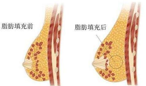注射式隆胸多少錢？