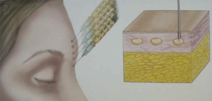做自體脂肪填充面頰后，會不會出現(xiàn)凹凸不平？