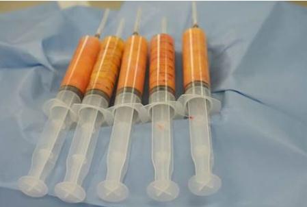 做自體脂肪填充能保持多久？