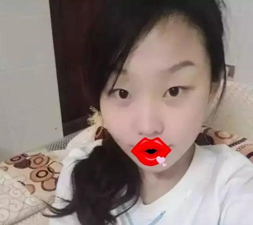 紹興維美整形做的祛斑+瘦臉+雙眼皮手術術前