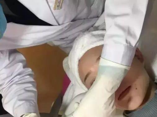 紹興維美整形做的祛斑+瘦臉+雙眼皮手術術后第2天