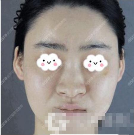 23歲的我到武漢愛(ài)思特做了硅膠隆鼻手術(shù)，鼻梁高！
