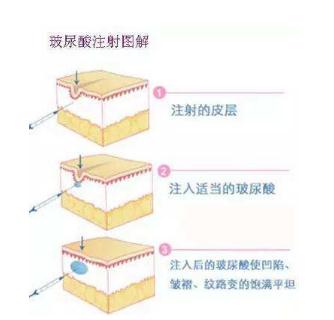 玻尿酸注射祛法令紋