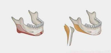 顴骨內(nèi)推和磨骨有什么區(qū)別？