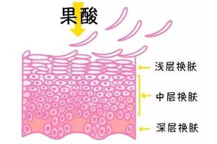 果酸換膚醫(yī)美項目原理