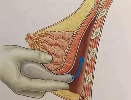 假體隆胸手術中采用哪種手術切口會比較好?