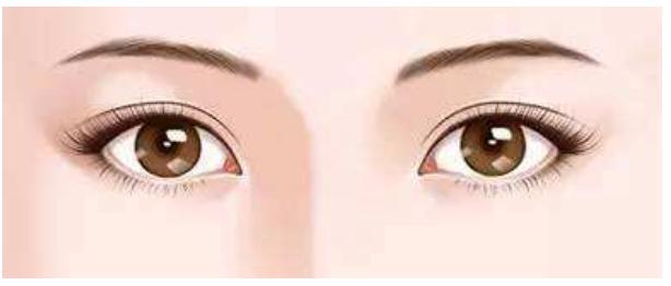 做韓式三點式雙眼皮手術(shù)果好嗎？