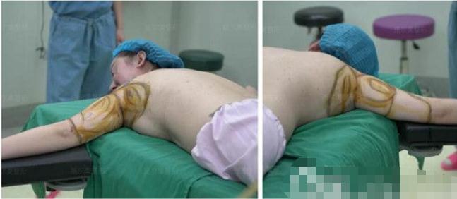 做手臂吸脂術(shù)手術(shù)術(shù)前準(zhǔn)備