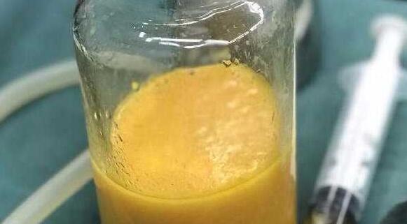 做自體脂肪填充能保持多久？