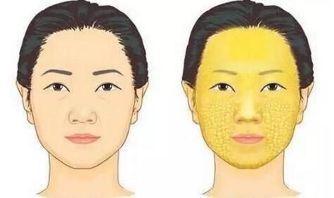 自體脂肪填充面部是否會出現(xiàn)凹凸不平？